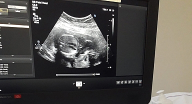 Karaman'da Bebeklerin Kalp Rahatsızlıkları Daha Doğmadan Tespit Edilebilecek